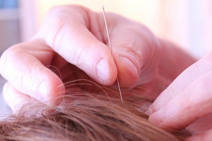 Facial Acupuncture: Unlocking the Power for Rejuvenating Your Skin